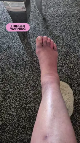 tigger warning can't believe the bruising on my foot i fell down some stairs in Costa and fractured a bone in my foot im managing to walk on it now without the bloody crutches #fypviral #fyppppppppppppppppppppppp #foryoupage #scottishtiktok 