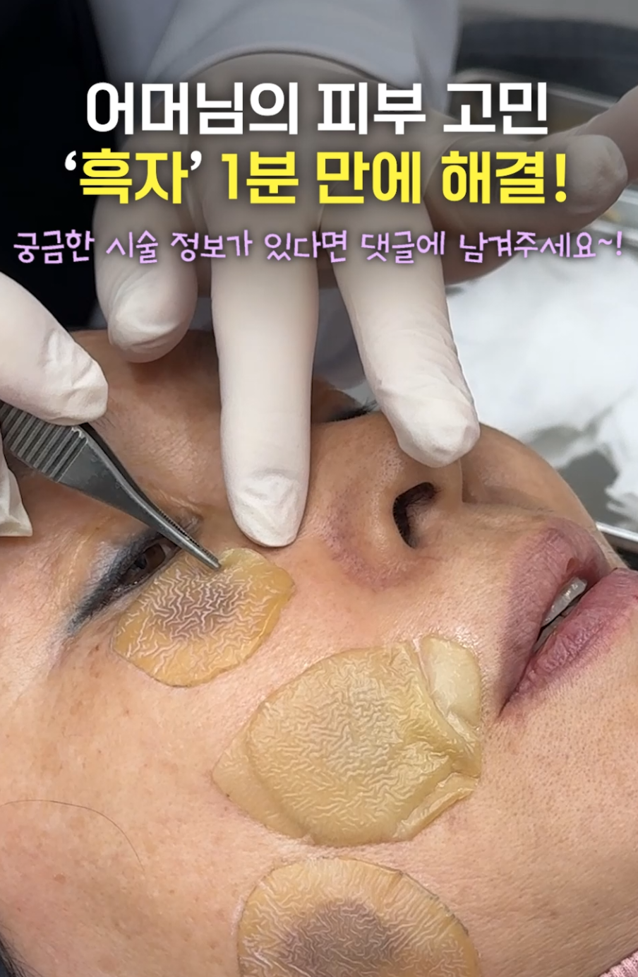 (2편) 🔥이제 더 이상 #흑자 고민 끝! 단 한 번에 제거 가능!🔥 #흑자제거 #잡티제거 #기미 #잡티 #검버섯 #색소침착 #리팟 #리팟레이저 #레이저 #흑자레이저 #밴스의원 #밴스밴스 