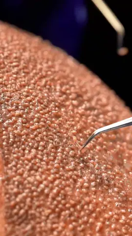 After hair transplant, there’s still hair loss 🥲 #hairdocrealresult #hairloss #alopecia #hairtransplant #notlaser #painless #hairregrowth #rambutmaksimal 