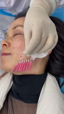 Cheek treatment with PDO threads  #threadlift #nonsurgicaltreatment #nonsurgical #facelift #london #nursepractitioner 