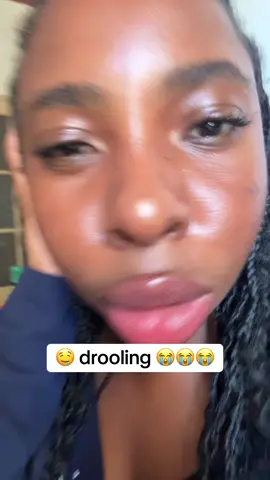 Disadvantages of having big lips #biglips #DSL #blackgirlproblems #lips 