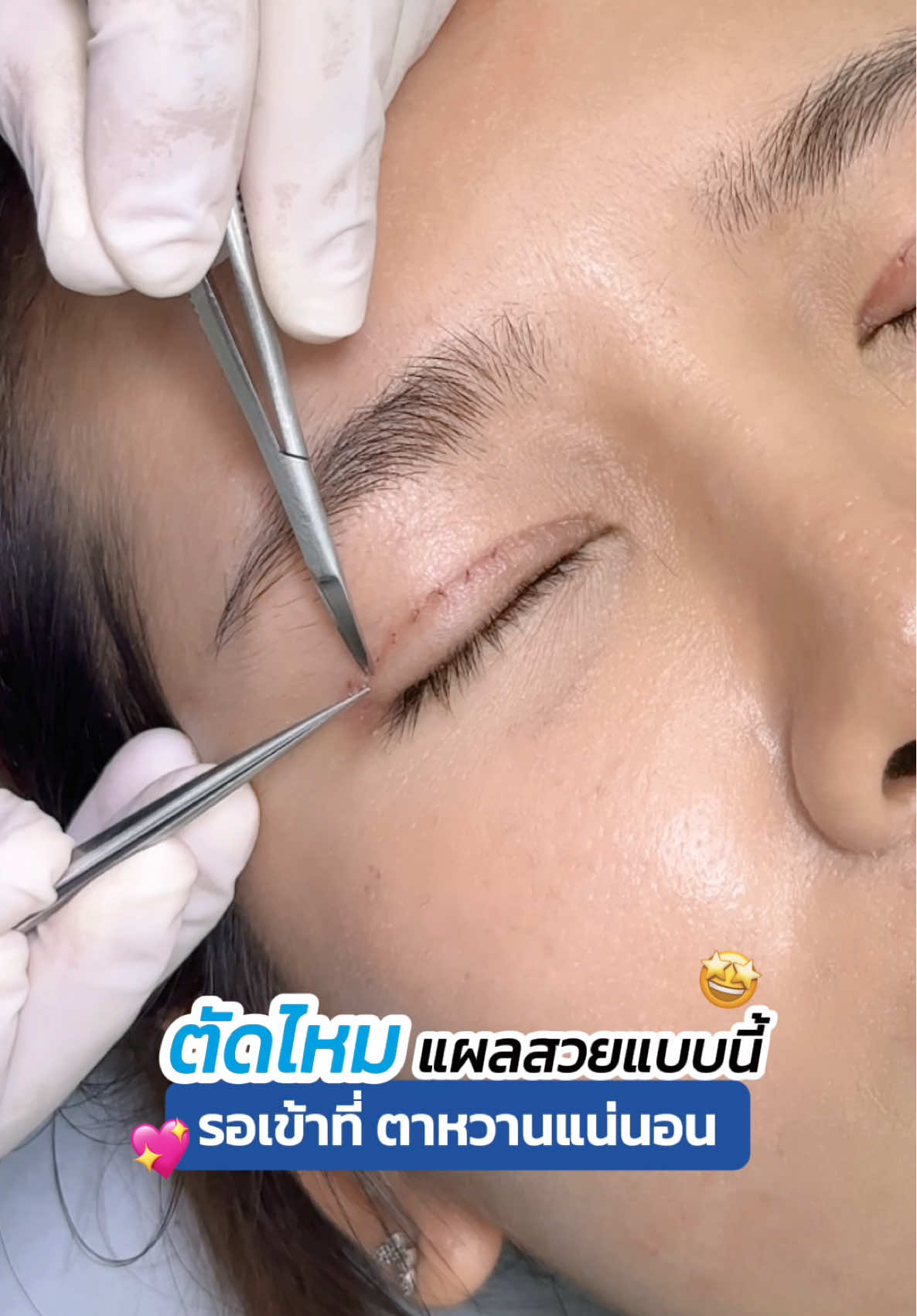 ตัดไหมตาสองชั้น แผลสวยขนาดนี้ ⁉️🤩 #รีวิวตาสองชั้น #หมอสกาย #skyclinic #จักษุแพทย์ #สกายคลินิก #ทำตาที่ไหนดี #ศัลยกรรมตา #sweeteyes 
