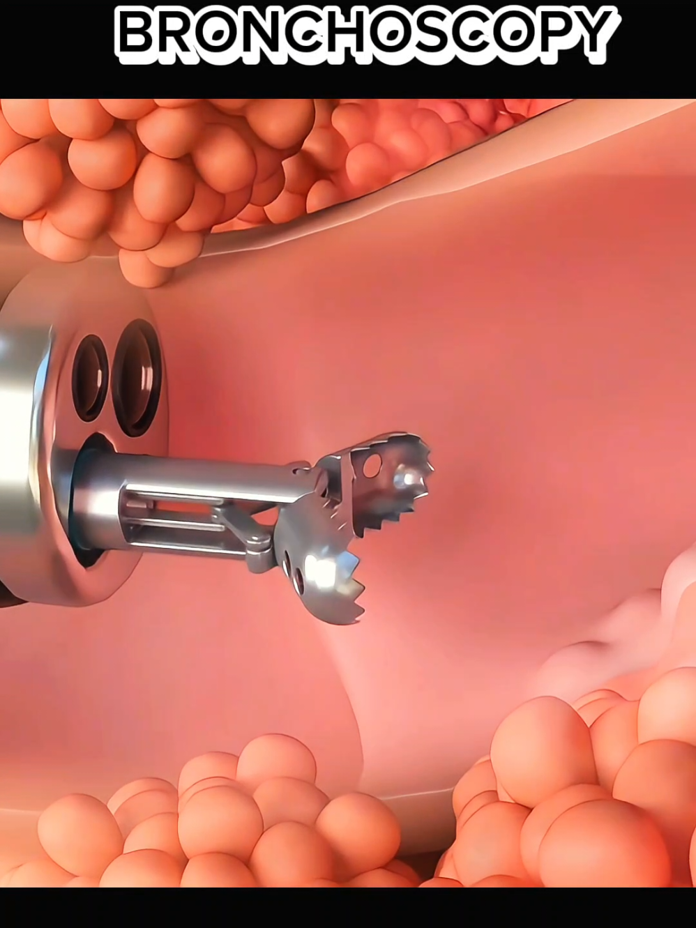 bronchoscopy or lungs biopsy: #LungBiopsy #Bronchoscopy #LungHealth #MedicalProcedure #LungDiagnosis #Bronchoscope #LungDisease #PulmonaryCare #LungCancer #RespiratoryHealth #MedicalTesting #BronchoscopyProcedure #LungBiopsyProcedure #ChestHealth #InvasiveProcedure #PatientCare #HealthAwareness 