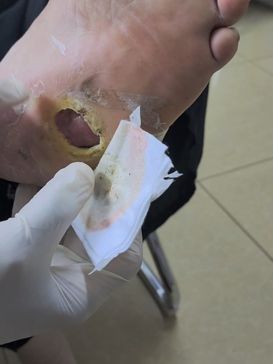 #diabetes #kencingmanis #diabeticfoot #wound #kudis #CapCut 