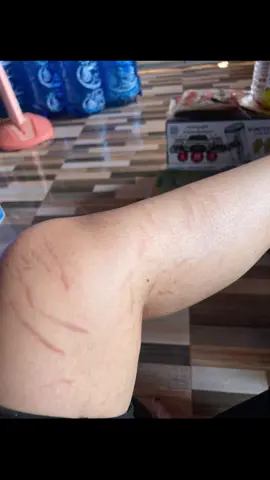 សង្វាបាត់ស្ទើរ100% គាត់ប្រើ អស់7កំប៉ុង#essuragluta #essurabrown #essuracollagen #essurablue 