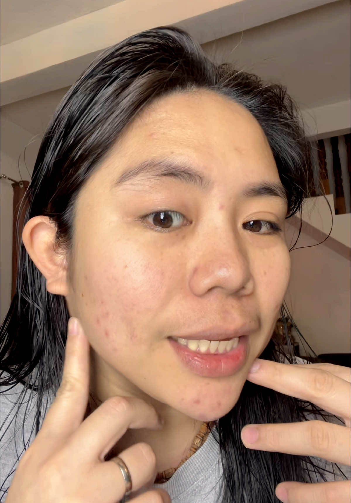 2nd day using this The Originote Brightening Moisturizer ✨🫶♥️ #moisturizer #theoriginote #pimplemarks #acnemarks #moisturizerviral 