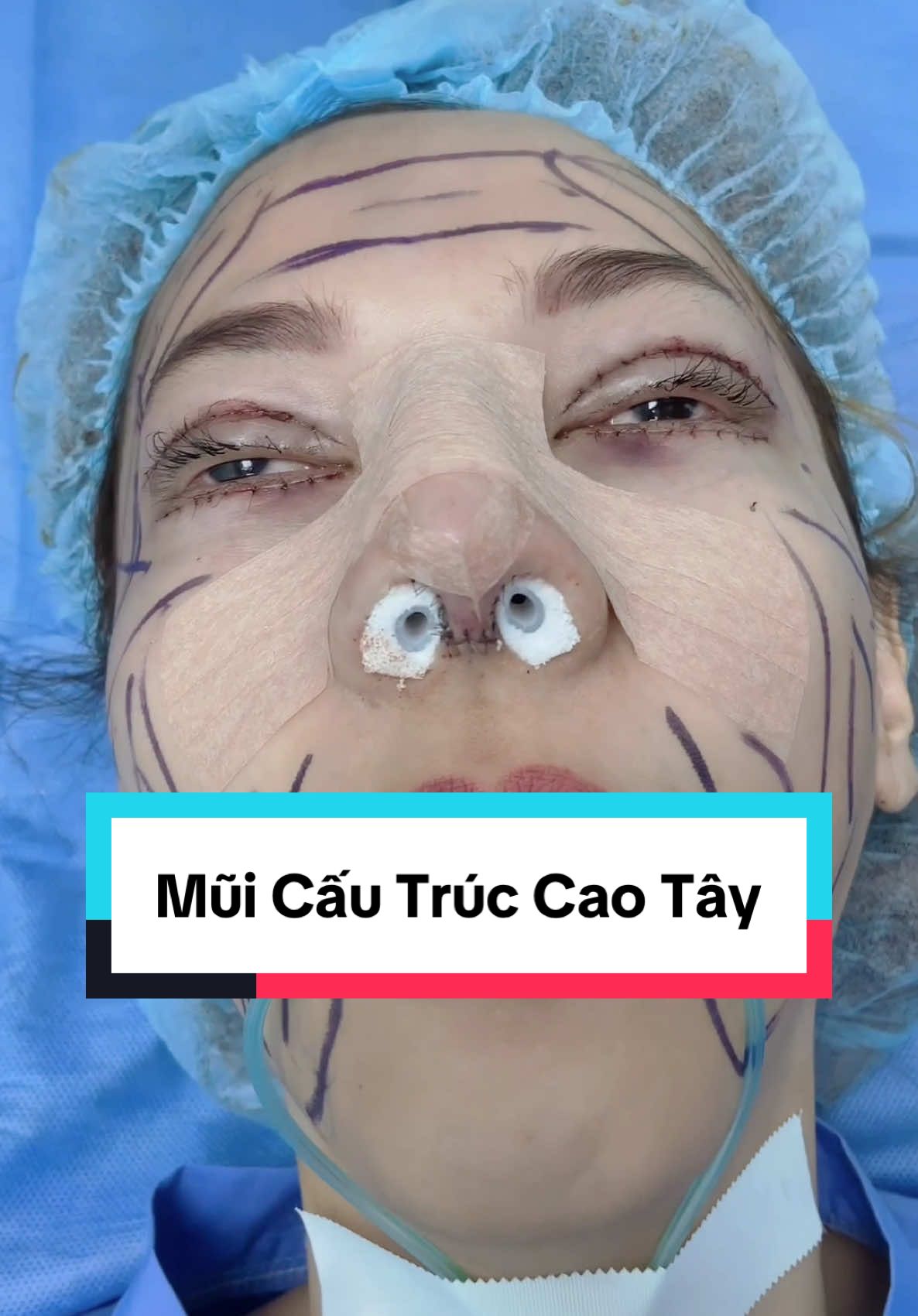Pengencangan hidung ala Turki ... #indonesia🇮🇩 #operasihidung #hidung #rhinoplasty #bsiviet 