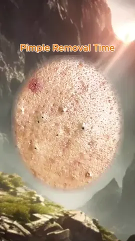 #squeezeyuk #satysfying #pimple #foryou #relax 