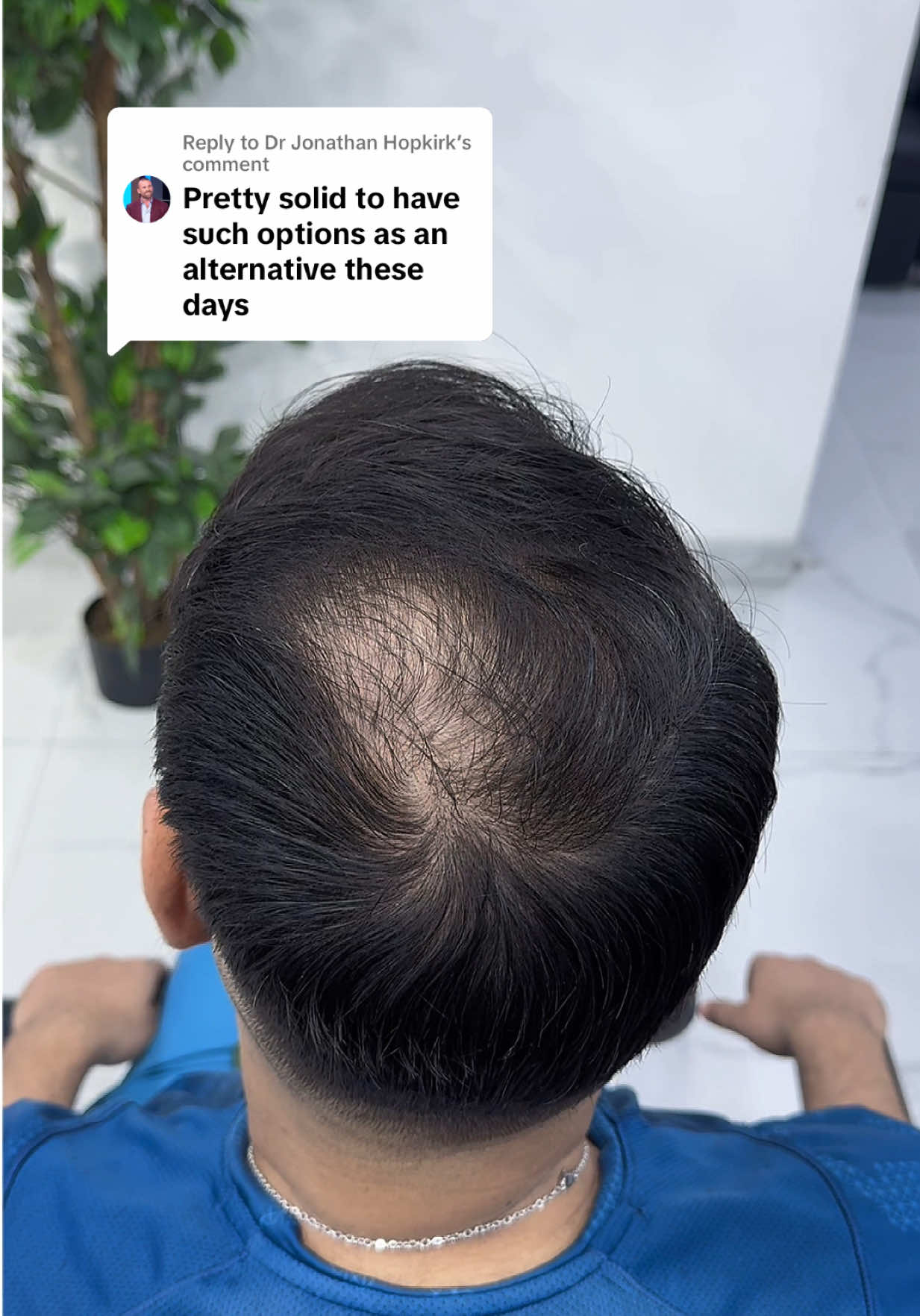 Replying to @Dr Jonathan Hopkirk  you know it’s for real when a Doctor comments, thank you! Link in bio. 🧡 #HairBear  #hairtransformation #menshair #hairtransplant #hairloss #hairfibers #fyp #hairfall #hairtransplantturkey #fyppppppppppppppppppppppp #minoxidil #2025 