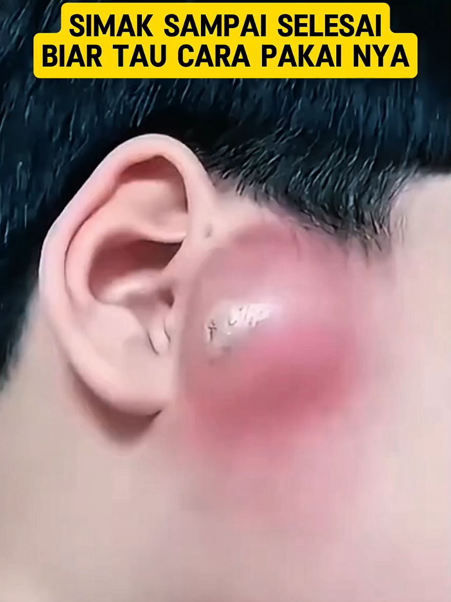 punya benjolan , rutin pake ini #salep #benjolan #benjolandileher #lipoma  #saleplipoma  #tiktokshop #fyp 