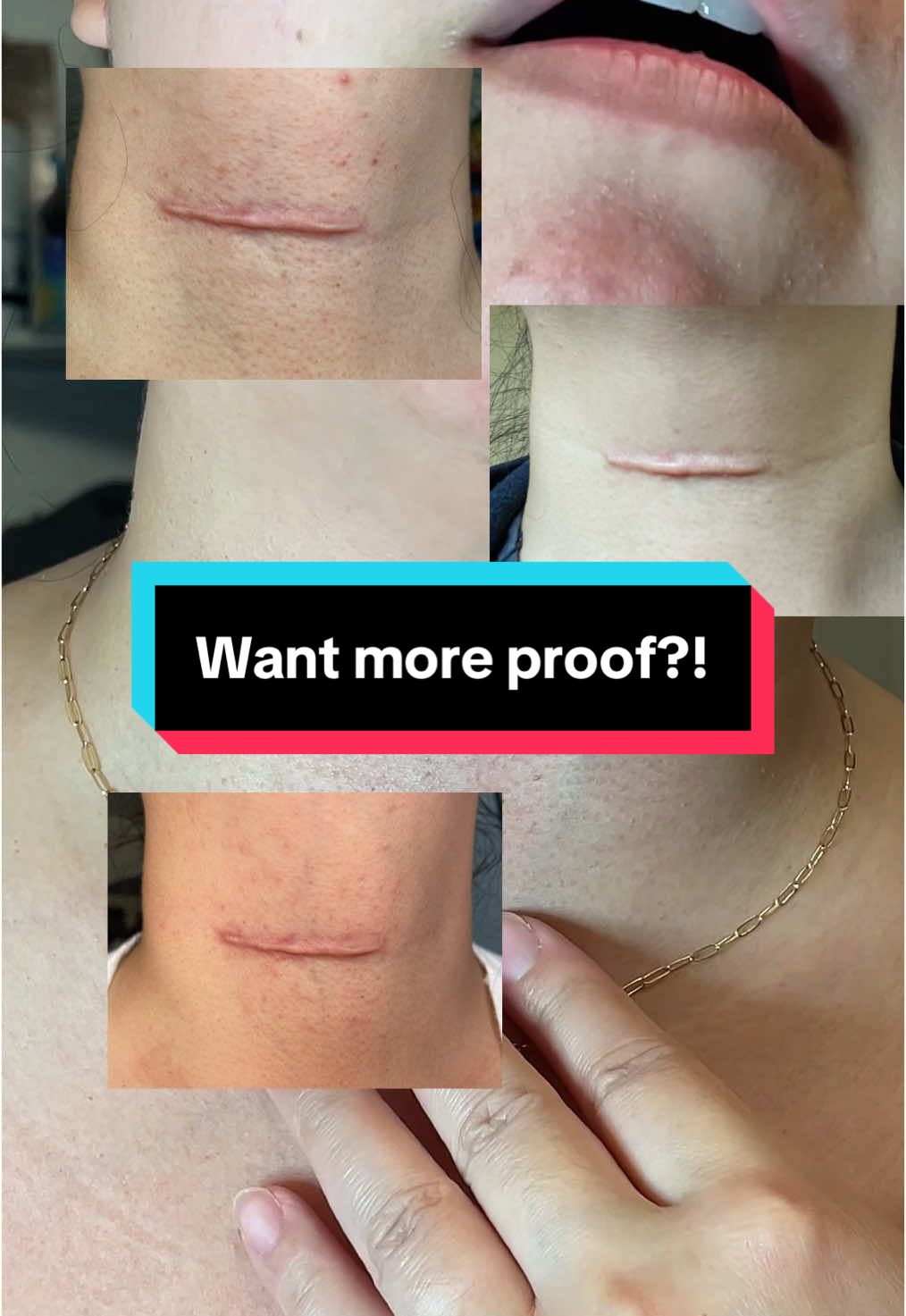 A Must have product to reduce or fade your scar that is currently over 70% off! Hurry and grad yours today! #scarcream  #dermatologistscarcreamresults  #scaraway #beforeandafter  #scarremovalcream #flashsale #scar #scarremover #scarstoyourbeautiful  silicone scar gel best scar cream