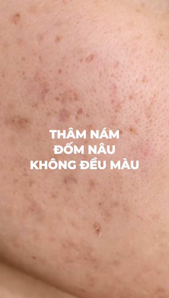 Da thâm nám, đốm nâu và không đều màu? 😱 👉 Giải pháp: Chọn Cafuné Melasma Gel Cream! Kem xoá mờ thâm nám, tàn nhang và làm đều màu da tối ưu. #thecafune #kemnamcafune 