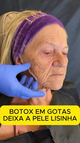 O site do tratamento está no meu perfil! #pelesaudavel #acidohialuronico #pelehidratada #mulheres #bigodechines #rejuvenescimentofacial #rejuvenescer #resveratrol #transresveratrol #skincare #tratamentofacial #pelesemrugas #calcificacao #mulher #vitaminac #rejuvenescimento #pelesemmanchas #mulhertrans #pele