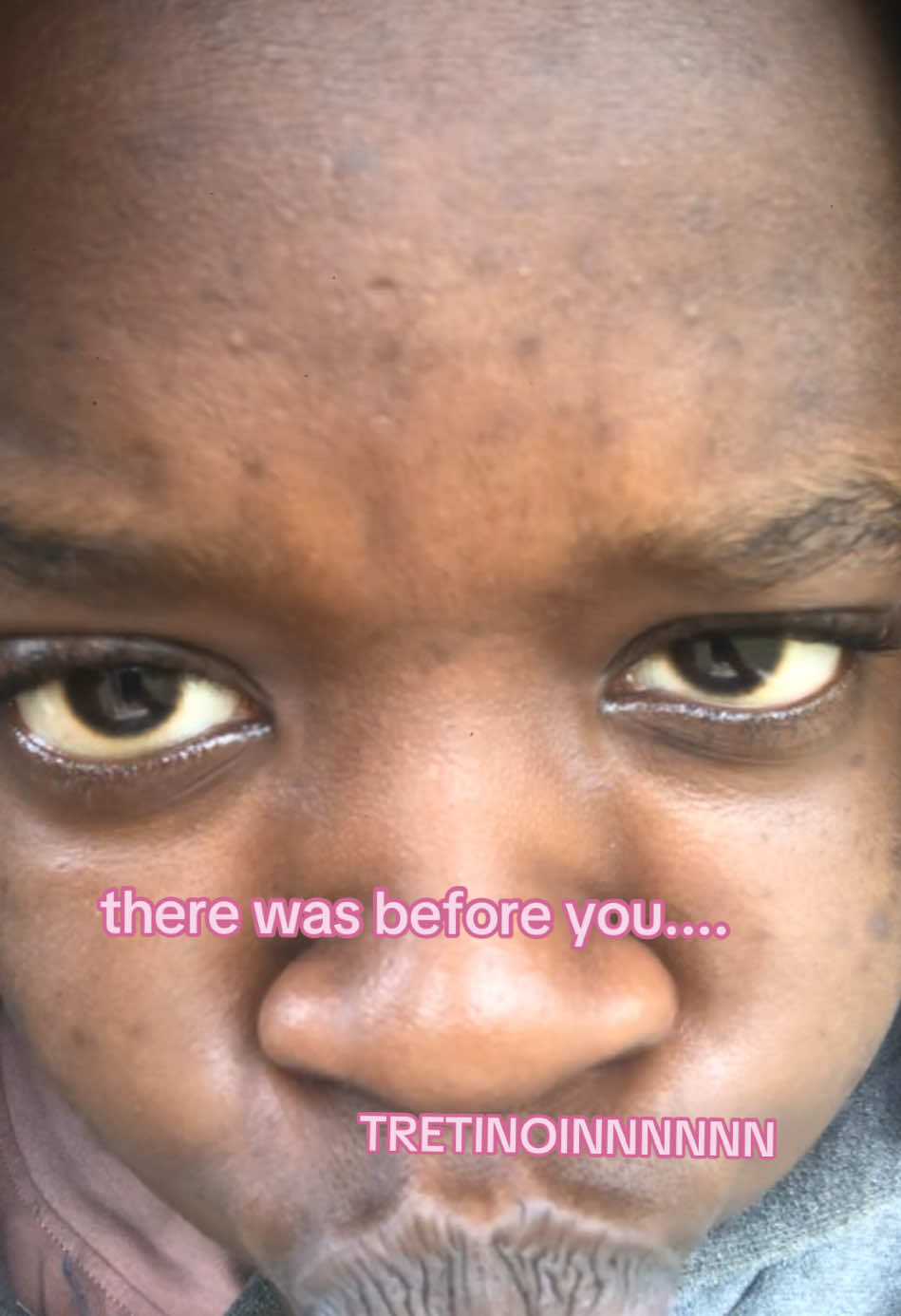 The journey was a very depressing one😭😭 I cried on some days, I hated taking videos without filter, it even got to a point that filters. We’re no longer hiding it, even though I’m not where I want to be, I’d forever be grateful to Tretinoin #tretinoin #skincarejourney #acneskin #beauty #selfconfidence #itgirl #contentcreation101 #influencer #fypシ゚ #clearskin #selflovejourney 