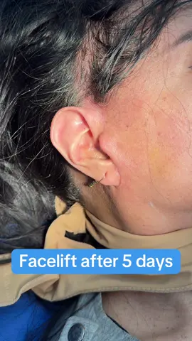 #surgery #operation #thammy #facelift #cangda #cangdagiauchi 