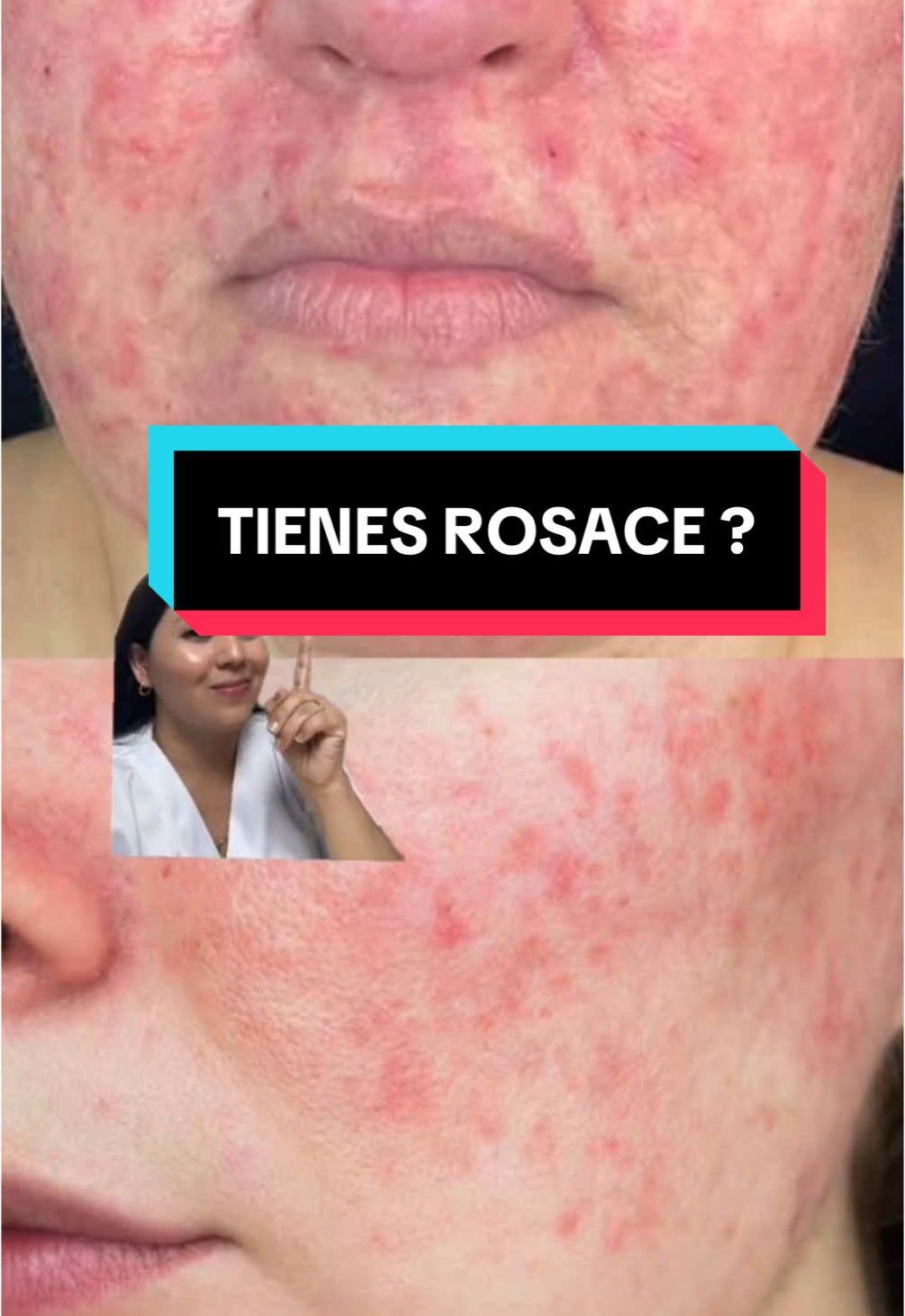 👩🏻‍⚕️Productos que recomiendo para pieles con rosácea: 1️⃣ GEL LIMPIADOR PARA PUEL SENSIBLE ANTIROSÁCEA 2️⃣ GEL DE IVERMECTINA O METRONIDAZOL  3️⃣ AGUA THERMAL ¡Recuerda acudir a tu dermatóloga de confianza! 📲989 093 766 🏥Lima - Perú  #rosacea #enrojecimiento #pielsensible #dermatologa #dermatology #dermatologia #skincare 