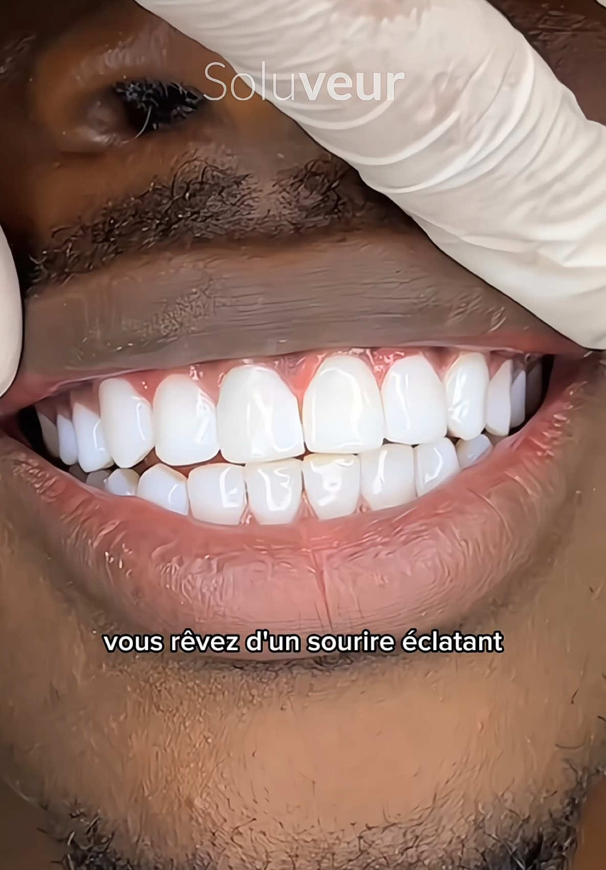 25 000 FCFA | Disponible au Congo 🇨🇬 | Livraison Gratuite Commander 📞 +242 05 349 39 41 #blanchimentdentaire #serumv34 #glorysmile #hismile #boutique #ecommerce #brazzaville #pointenoirecongo/ #livraison #livraisongratuite #tendancetiktok