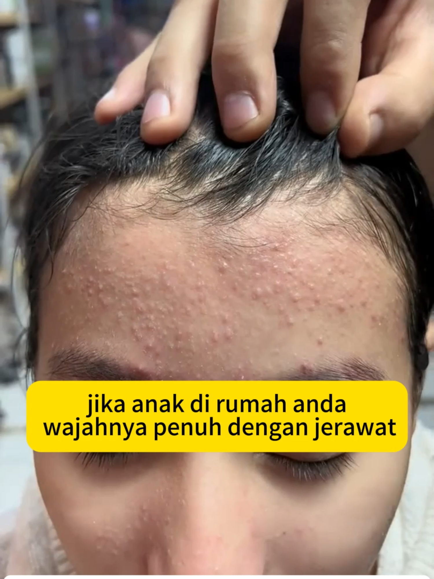 Juruselamat kulit berjerawat! Formula bebas asam, menenangkan jerawat dalam 7 hari!#jerawathilang #skincarelokal #TikTokShopBeauty #AntiJerawat #ReviewSkincareLokal