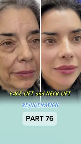 Deep Plane Facelift by Dr. Lyna (Part 76)#tiktokmalaysia #drlyna #facelift #cosmeticsugery #cosmeticsu #tiktokmalaysia🇲🇾 #xuhuong 