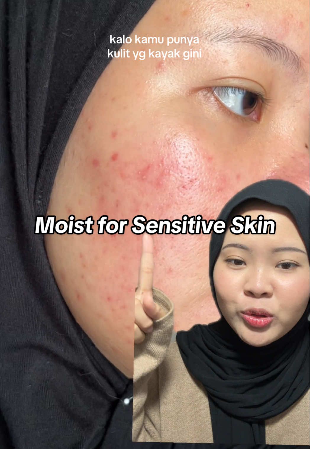 ringan tapi melembabkannya cukup buat kulit sensitif #acneproneskin #acnefighter #sensitiveskin #redness 
