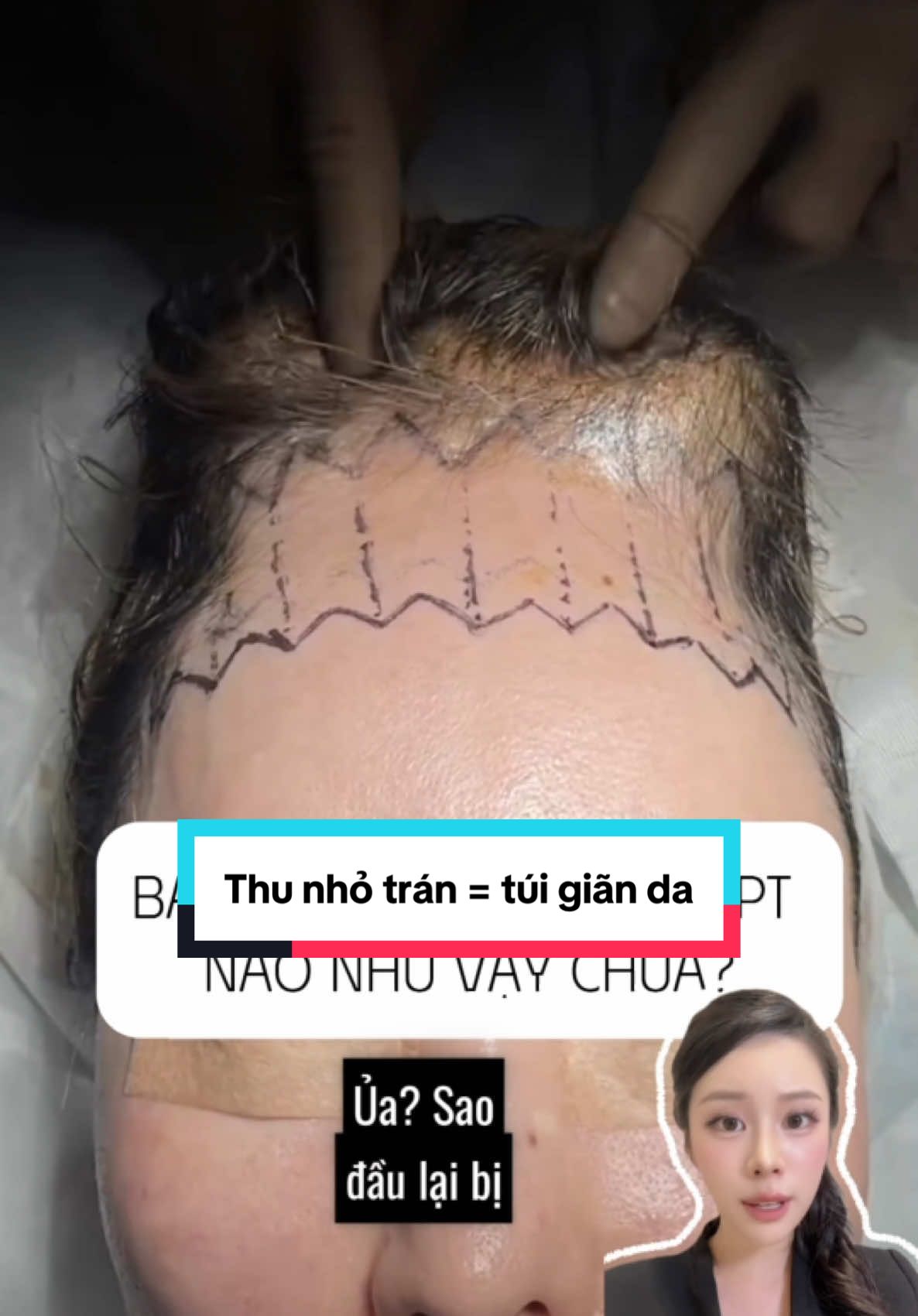 Mn đã từng nhìn thấy ca PT nào như thế này chưa? Yuna Thẩm Mỹ 🇰🇷🇨🇳: Info đầu trang #thammytrungquoc #dulichthammytrungquoc #pttmtrungquoc #pttmhanquoc  #pttm #thammy #dulichthammyhanquoc #pttmtaihan #dulichthammytrungquoc #pttmtrungquoc #phauthuattaihan #dulichthammy #pttmtaitrungquoc #nangmui #catmi #hutmo #gotham #hanquoc #trungquoc