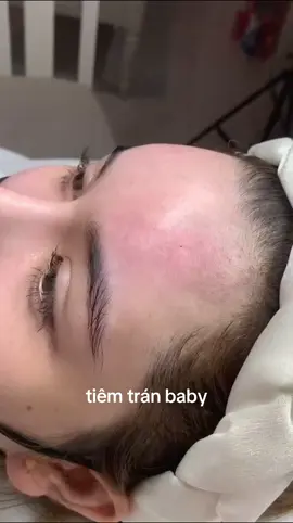 trán baby #tiemtranbaby  #tiemtrantrunghoa 