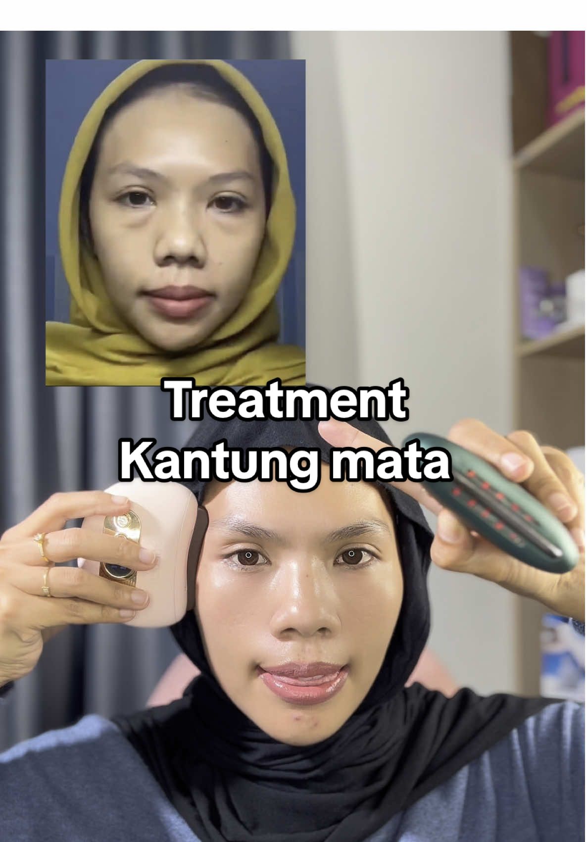Kantung mata itu bikin wajah keliatan lebih tua #guasha #guashaelectricmassage #treatmentkantungmata 