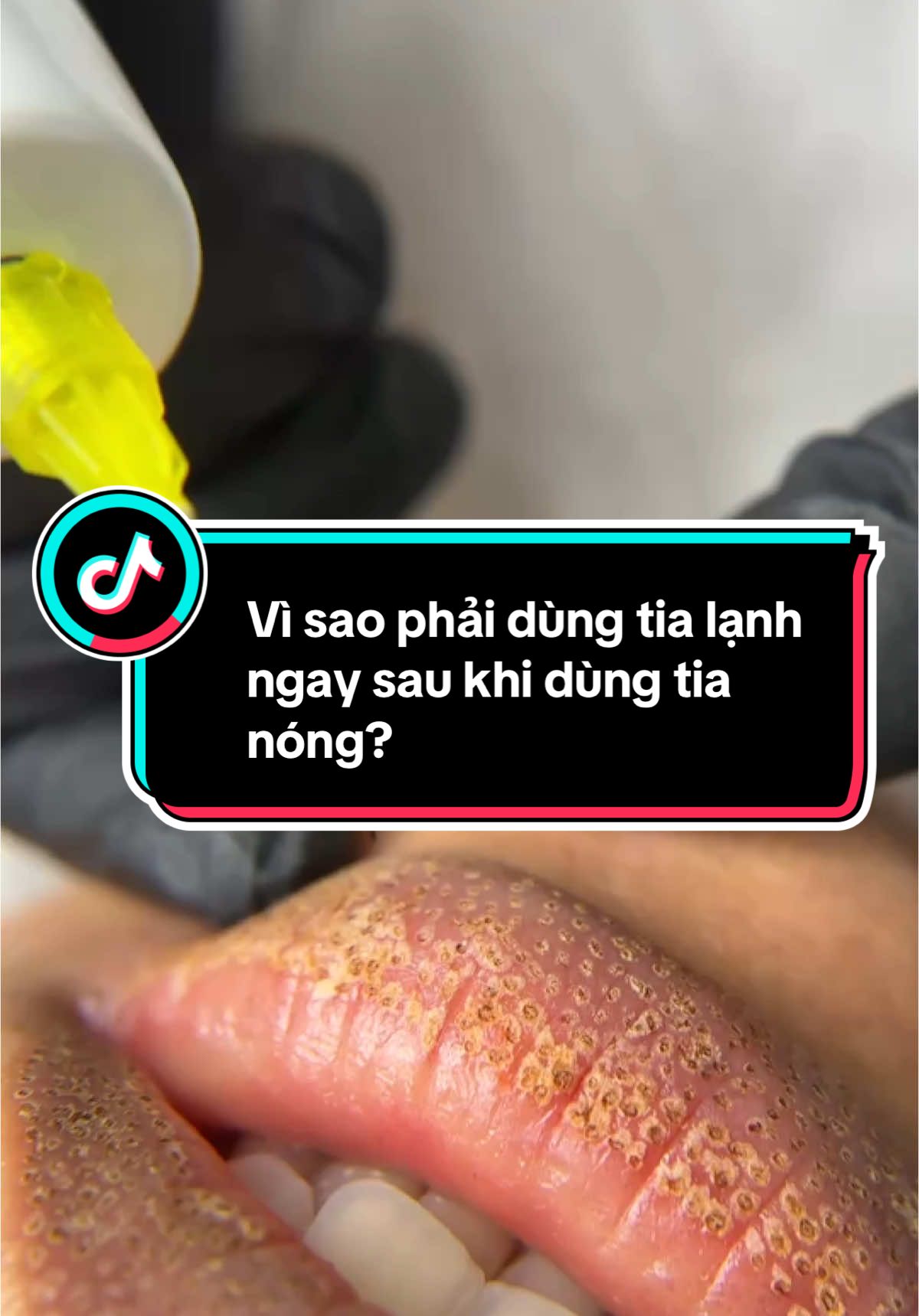Vì sao phải dùng tia lạnh sau khi dùng tia nóng trong tất cả mọi trường hợp của Plasma PAA ##bichnganbrowscantho 