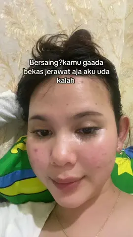 #acnefighter 