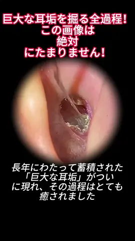#earcleaning #earwaxremoval #earwax #satisfyingvideo #satisfying #satisfyin #asmr 