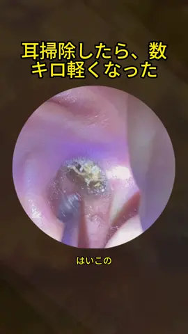 #耳垢ナカショー #耳垢掃除 #耳掃除 #earwax 