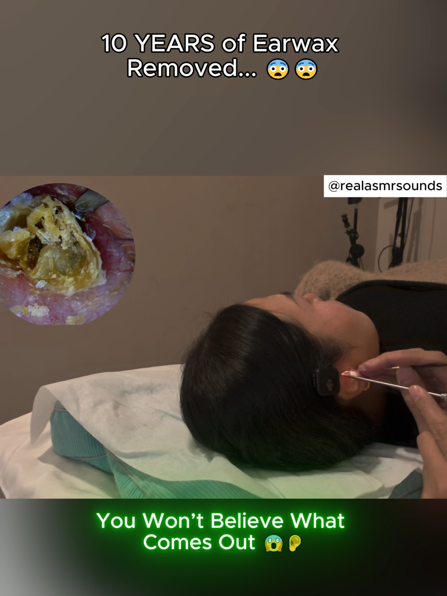 She Didn’t Know This Was in Her Ear for 10 Years#relaxing #foryoupage #asmr #satisfying #viral #longervideos #chinatiktok #trending