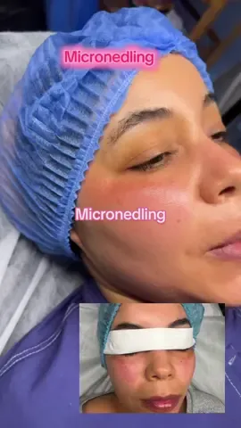 Micronedling  #microneedling #hydrafacial #hydrafacial #hydra #soins #soukra #aouina #libya🇱🇾_tunis🇹🇳_algeiar🇩🇿 #نضارة_البشرة 