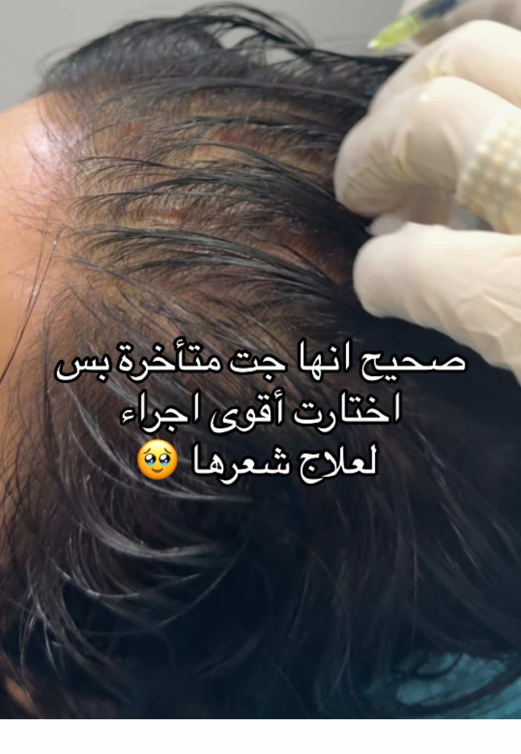 اكسوزوم الشعر ، ينقذك حتى لو جيتي متأخرة 🥹 . #اكسبلور #اكسبلورexplore #تساقط_الشعر  #عيادات_تجميل #الرياض #foryoupage #fypシ゚ 