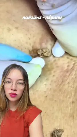 Olha isso #extractions #cravos #limpezasatisfatoria #terapia #limpezadepele 