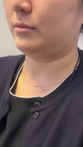 まさかまだ…インモードだけ⁉︎🖐️ NONO! インモードだけだと、 たるんじゃうかもしれませんよ！🥲 KATE医院の インモードユニバースなら 輪郭注射＋インモード＋シュリンクユニバースの ３つがセットに🙋🏻‍♀️✨ 👇👇 ①輪郭注射で脂肪を溶かし、 ②インモードで細胞レベルから破壊、 ③シュリンクでギュギュっと上げちゃいます！⇧ ＜KATEのこだわり＞ 40度以上で、1部位あたり5分以上照射しないと 効果がないと言われているインモード。 KATEでは40度＆5分以上施術を厳守します！ 今まで効果がなかった人は、 時間や温度が問題だったかもしれません🥲 気になることは、 LINEからいつでもご連絡ください🤳 日本人通訳がなんでもお答えします！ #脂肪溶解注射 #韓国皮膚科 #韓国美容皮膚科 #美容皮膚科 #アンチエイジング #シュリンク #インモード #輪郭注射 #韓国美容 #リジュラン #リフトアップ #小顔矯正 #二重あご #顔痩せ