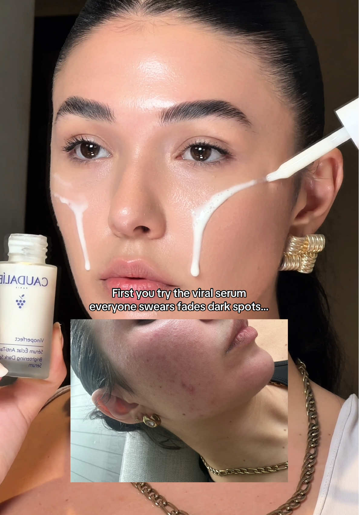 The @Caudalie Vinoperfect is a serum I’ve used for 3/4 years now, and it’s never let me down. Anytime my skin breaks out badly (which it does often), I reach for this. It helps calm everything and fade the dark spots before they turn into scars. My skin and I have a complicated relationship, but this has always been a staple in my routine -even under makeup it gives the best glow too!!ad ✨ #creatorsearchinsights #caudalie #vinoperfect #darkspots #skincare 