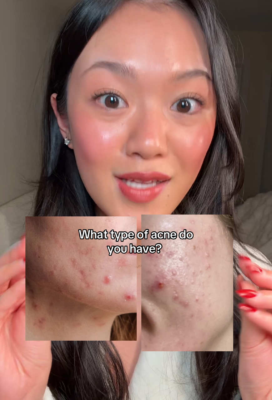 First step to clearing your skin is finding out what’s wrong with it. Lots of things can lead to ‘red bumps’ so here’s some tips on how to tell! 💗 #acnetips #clearskin #clearskintips #clearacne #greenscreen 
