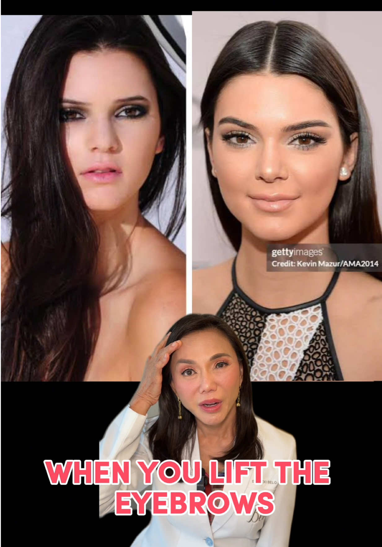 enhancements done RIGHT! love how Kendall Jennee elevated all her beautiful features with all the right tweakements 💕 #kendalljenner #kendalljennerstyle #kardashian #kardashianjenner