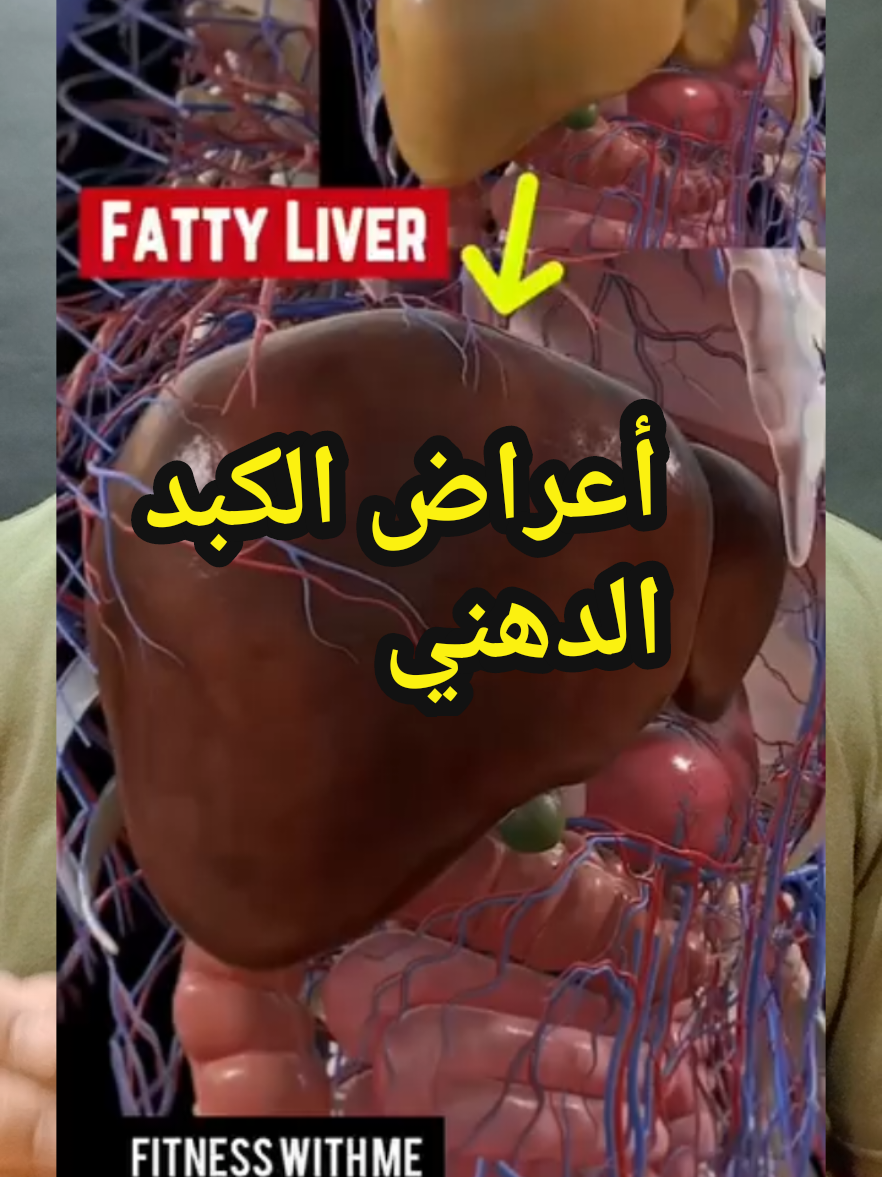 ازاي تعرف ان عندك كبد دهني  #wellness #Fitness #medicaladvice #diet #fat #goodlife #live #health #heal #healthy #healthylifestyle #healthyliving #healthyfood #كبد #حمية #رجيمات 