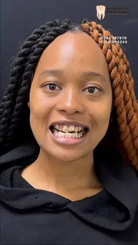 Diagnosis: Dental Fluorosis (blame that on borehole water💧) 📲 07.40.18.75.79 | 07.48.09.52.43 #fyp #fypp #fyyyyyyyyyyyyyyyy #dental #dentistryworld #thikaroad #fyppp #dentist #dentalhygiene #whitening #kidsoftiktok #veneers #nairobi #crowns #tiktoknairobi #teethwhitening 