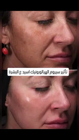 لبشرة تبرق ترعد 🔥😉 سيروم الهيالورونيك أسيد يعتبر من أفضل المنتجات اللي ممكن تستخدميها لترطيب البشرة والعناية بيها، وده لأنه بيتميز بقدرة عالية على جذب وحبس الرطوبة. خليني أقولك على أهم فوائده: 1. ترطيب عميق للبشرة: الهيالورونيك أسيد بيحبس الرطوبة في الجلد، وده بيخلي البشرة تبان ناعمة ومنتعشة ومليانة حياة، خصوصاً لو بشرتك جافة أو فيها قشور. 2. تقليل الخطوط الدقيقة والتجاعيد: لما البشرة تكون مرتوية كويس، التجاعيد والخطوط الرفيعة بتقل بشكل ملحوظ وبتبان البشرة مشدودة أكتر. 3. مناسب لكل أنواع البشرة: سواء كانت بشرتك دهنية، جافة، مختلطة أو حساسة، السيروم ده غالبًا هيشتغل معاها من غير ما يسبب تهيج أو انسداد في المسام. 4. يساعد على تهدئة البشرة: خاصة بعد التعرض للشمس أو بعد استخدام مقشرات قوية. 5. بيعزز مرونة البشرة: مع الاستخدام المنتظم، البشرة بتبدأ تبان مشدودة أكتر ومرنة، وده بيخلي المظهر العام أصغر سناً. 6. تحضير البشرة قبل المكياج: بيخلي البشرة جاهزة لاستقبال المكياج بشكل ناعم ومن غير تقشير أو تشققات. #مستورد_العناية #الاحساء #السعودية #مستلزمات_صيدليات #عناية #هدايا #بنات #عناية_بالبشرة #بشرة_صحية #سيرومك_المفضل 