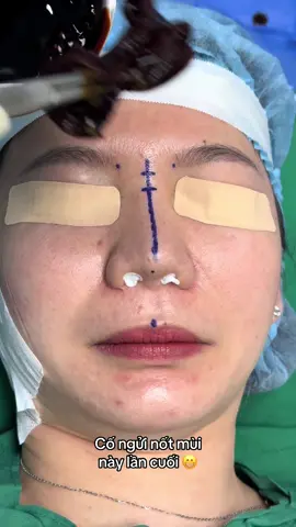 #nangmui #xuhuong #bsphamhao #suamuihong #gheptrungbi #lamdep 