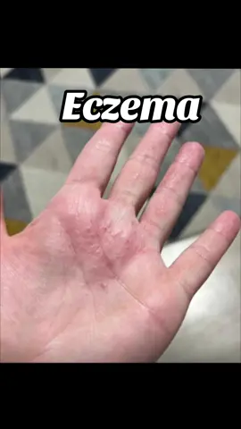 #eczema #eczematreatment #handeczema #skincare #zudaifusoap #zudaifu #yiganerjing 