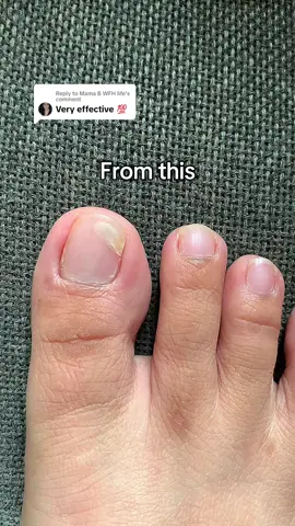 Replying to @Mama B WFH life Broken Nails? Use this Ginger Nail Essence from RtopR now💯 #gingernailessence #rtoprgingernailessence #rtopr #nailtreatment #nailcare #gingernail #nails 