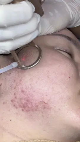 🇻🇳🇻🇳 MỪNG ĐẠI LỄ 30/4-1/5          bên em Ứng dụng công nghệ Lazer CO2 FRACTIONAL- Thay đổi vi điểm🥰 ❗️Thu nhỏ lỗ chân lông.            ❗️Làm sáng đều màu da.          ❗️Làm mờ thâm nám.                        ✨ GIÁ GỐC 25** ❌ Ưu đãi hôm nay CHỈ CÒN 899k                                           ❗️❗️ ĐẶC BIỆT TẶNG thêm 1 buổi chăm sóc da chuyên sâu 7 bước cho mọi người sau khi đăng kí làm bên em                                          🤙 Nhanh tay ib cho e để không bỏ lỡ cơ hội vàng để chăm sóc da vừa khoa học , vừa hợp túi tiền còn được ưu đãi tặng quà nữa nhé🫶🫶#thammy #lazer #tặngquà 