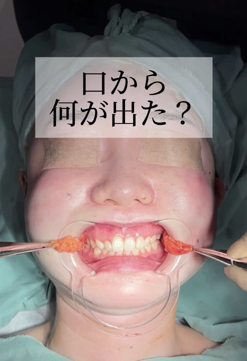 口から何が出た？#バッカルファット #小顔整形 #脂肪吸引 #整形