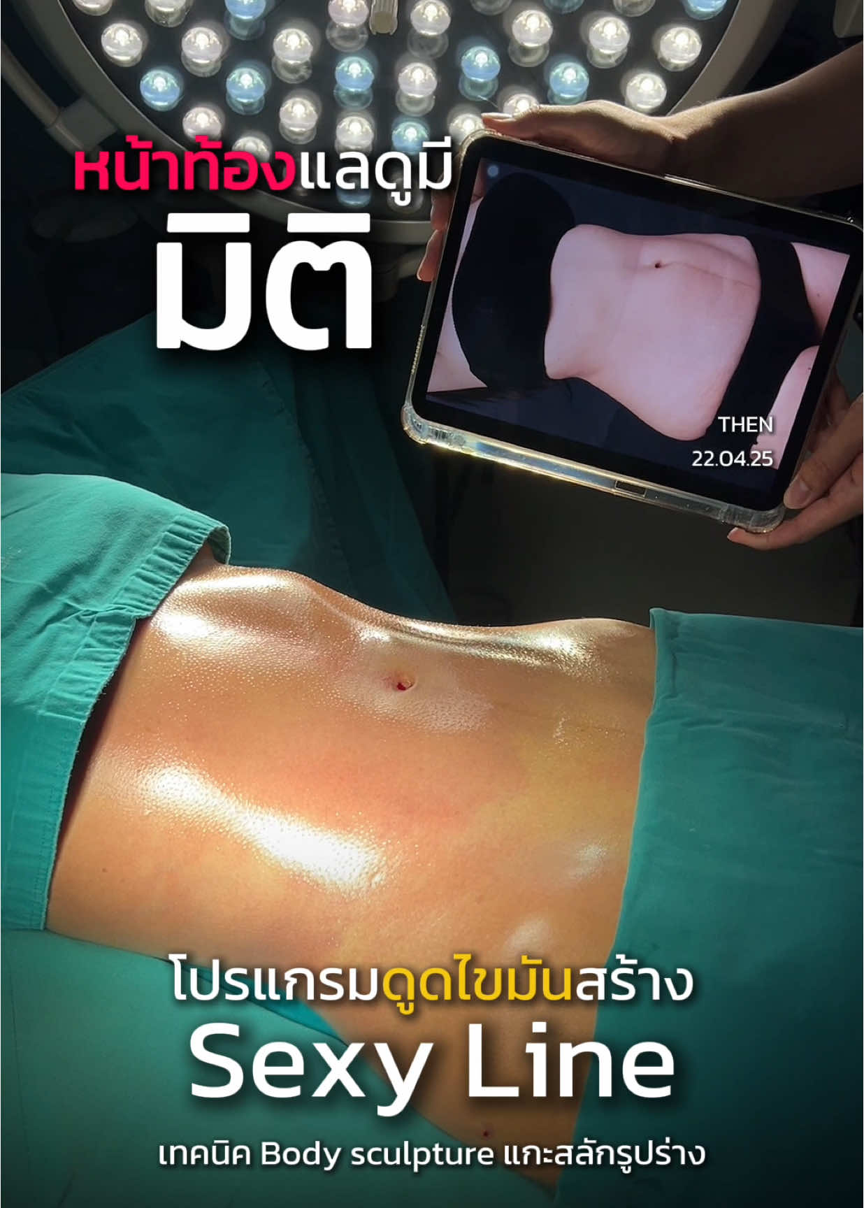 หน้าท้องและดูมีมิติ กับโปรแกรมดูดไขมันสร้างSexy Line ที่สาวๆพูดถึงกันมากที่สุด  #หมอเบียร์ดิอาท #ดูดไขมัน #sexyline #ดิอาทคลินิก 