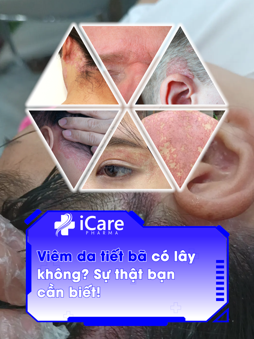 Viêm tiết bã da đầu có lây không? Sự thật bạn cần biết. #antisol #icarepharma #daugoiicare #daugoithaoduoc #namdadau #daugoitrigau #daugoi #trigau #daugoiantisol #gau #daugoitrinam #trendingvideo #viralvideos