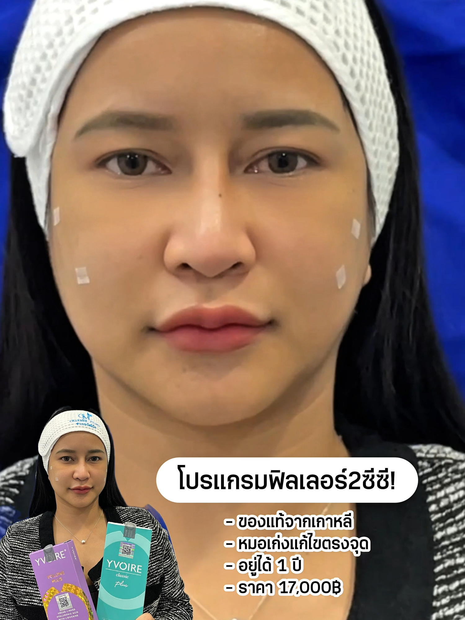 30ปีที่ผ่านมาทำอะไรอยู่น้อ ทำไมไม่มาทำให้เร็วกว่านี้ #charmerclinic #รีวิวบิวตี้ในtiktok #ใต้ตาดํา #ฉีดฟิลเลอร์ใต้ตา #ฟิลเลอร์ใต้ตา #ฟิลเลอร์ #ใต้ตาคล้ำ